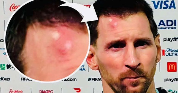 Messi sưng vêu trán sau trận thắng Cabo Verde: Vì sao nên nỗi? - hình ảnh - ok9tiger.com